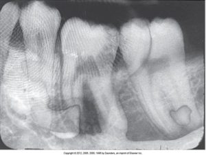 Dental X-ray showing a set of teeth with some distorted areas due to movement or improper film handling. A black fingerprint artifact appears on the film at the top.