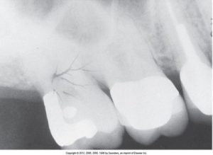 Dental X-ray showing teeth with a large filling and static electricity appearing as black branching lines on the far left tooth.