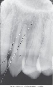 Dental X-ray showing teeth with a vertical white artifact resembling a scratch on the film.