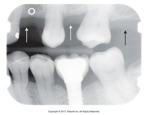 A dental X-ray depicting various teeth with arrows highlighting a dental implant and several areas of interest, indicating the gray areas of needed treatments or conditions.