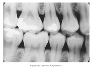 An interproximal dental X-ray showing the upper teeth with dental fillings.