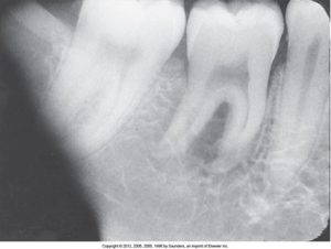 Dental X-ray showing a tooth with a root canal treatment and adjacent teeth with a portion of the film exposed to light appears black on the left.