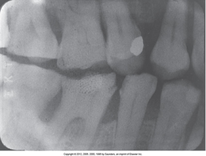 Dental X-ray with an uneven exposure that is a fogged film appearing gray and lacks detail and contrast.