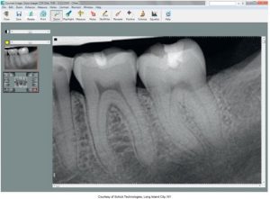 A computer screen with dental imaging software open, displaying a magnified periapical X-ray image of molars, courtesy of Schick Technologies, Long Island City, NY.