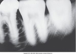 a blurred radiograph from patient movement