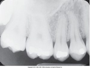 An X-ray image of maxillary anterior teeth, highlighting their structure and alignment for dental examination or diagnosis.