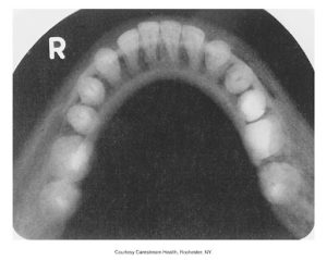 An occlusal X-ray image showing the arch and teeth of the upper jaw.