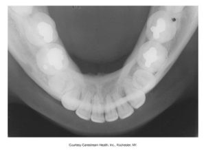 An occlusal dental X-ray showing a full arch view of the upper or lower teeth, used for assessing the overall tooth and jaw structure, provided by Carestream Health, Inc., Rochester, NY.