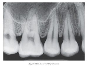 A close-up dental X-ray focusing on the root structure of several teeth.