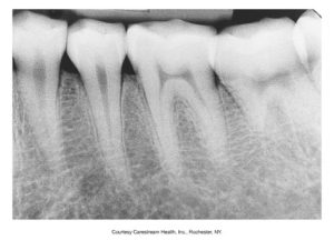 A dental periapical X-ray showing the detail of the lower molars and surrounding bone structure, provided courtesy of Carestream Health, Inc., Rochester, NY.