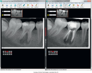 Computer screen displaying split-screen dental X-ray images with software interface, showing detailed views of teeth, provided by Schick Technologies, Long Island City, NY.