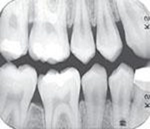 Dental bitewing X-ray showing upper and lower teeth with no apparent issues, but the image is cropped and lacks clarity, suggesting potential time or temperature processing errors. A diagnostic radiograph with images that exhibit proper density and contrast.