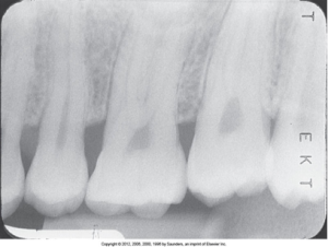 Dental X-ray showing teeth with slight overexposure due to underdeveloped film appears light.