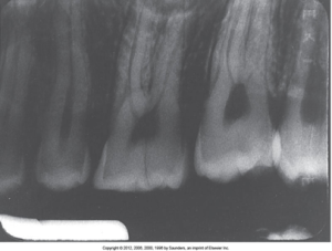 Dental X-ray showing underexposed teeth, resulting in a dark and unclear image, because of overdeveloped film.