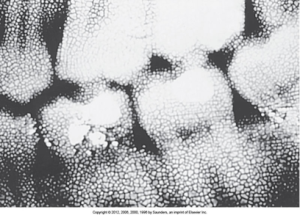 Dental X-ray with a reticulation pattern, indicating film emulsion damage due to temperature errors in processing.