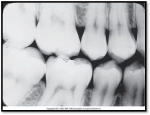 A dental bite-wing X-ray showing the details of upper and lower teeth, used for detecting cavities and understanding tooth alignment.