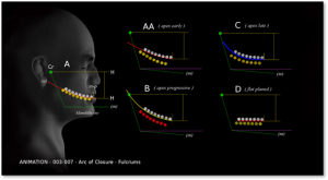 a human head in profile displaying the jaw and the Curve of Spee, with four different occlusal plane adjustments depicted by colored lines and teeth, illustrating variations in the curvature from early to late apex positions.