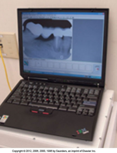 A laptop displaying a dental X-ray image of the mandibular right periapical region on its screen.