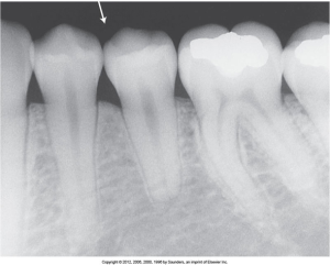 A dental X-ray showing a row of teeth with an arrow pointing to a radiolucent area above one of the teeth, indicative of an air space or possible pathology.