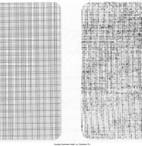 Illustrations of screen-film contact. Left, Cassette exhibiting good film-screen contact. Right, Cassette exhibiting poor film-screen contact.