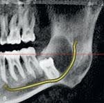 young adult patient presented to the dental office for a routine preventive appointment. The panoramic image reveals an impacted tooth 3.7.