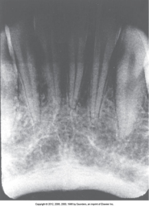 A dental radiograph showing an overexposed receptor, which appears dark, displaying the details of teeth and gums less distinctly.