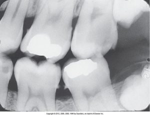 A dental radiograph with correct receptor placement for the molar bite-wing, displaying clear images of the molar teeth with distinct contours and no overlapping.