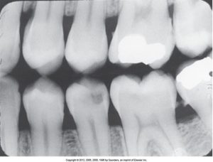 A dental radiograph with correct receptor placement for the premolar bite-wing, showing clear and well-defined images of the teeth without overlap or distortion.