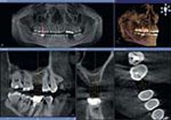 Diagnostic capabilities of three-dimensional cone beam imaging showing implant placement of tooth 1.6