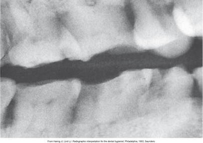 The image is a dental X-ray showing overlapping of teeth, indicating incorrect horizontal angulation during the imaging process.