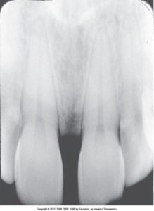 A dental radiograph showing too flat vertical angulation, resulting in elongated images of the teeth, which appear longer than their actual size.