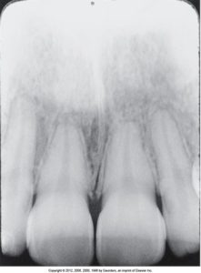 A dental radiograph showing too steep vertical angulation, resulting in foreshortened images of the teeth, which appear shorter than their actual size.