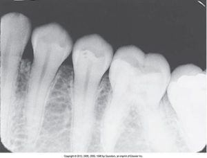 A dental radiograph depicting improper receptor placement, resulting in overlapping and unclear visibility of the tooth roots and crowns.