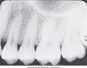 A dental radiograph displaying incorrect horizontal angulation, leading to overlapping of the contact areas between teeth, which obscures clear viewing of the spaces between them.