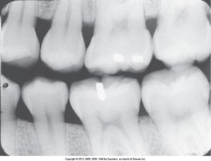 A dental radiograph showing incorrect receptor placement for the premolar bite-wing, resulting in unclear and overlapping images of the premolar teeth.