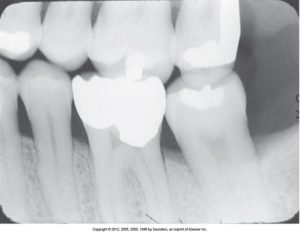 A dental radiograph displaying incorrect vertical angulation, leading to distorted images of the teeth, which appear elongated and unnatural.