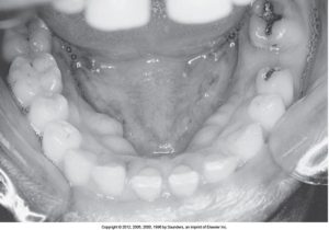 Black and white intraoral image showing the lower jaw and teeth with visible mandibular tori