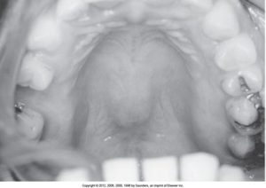 Black and white intraoral photograph showing the roof of the mouth and upper teeth.