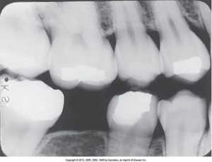 A dental radiograph showing incorrect horizontal angulation, resulting in overlapped interproximal contacts and obscured details between the teeth.