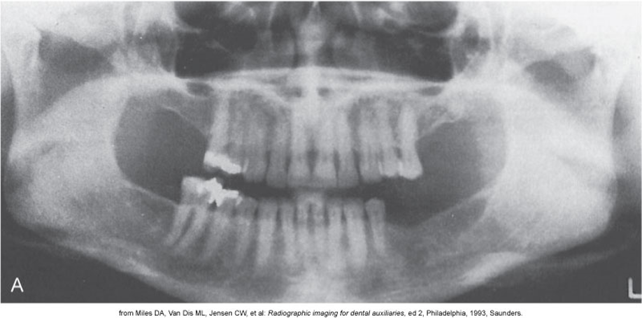 Panoramic dental X-ray showing the upper and lower jaws, teeth, and sinuses.