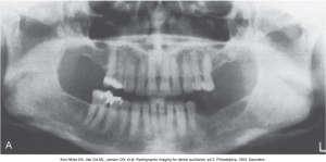 A panoramic dental X-ray showing both upper and lower jaws with visible teeth, used for diagnostic purposes.