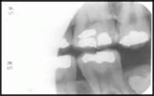 A dental radiograph showing incorrect receptor placement, resulting in a distorted and unclear image of the teeth.