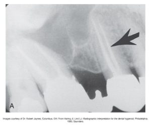 Dental X-ray showing the maxillary teeth with an arrow indicating the presence of gutta percha in a treated tooth.