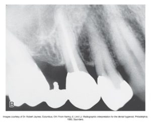 Dental X-ray showing the alignment and structure of lower jaw teeth.