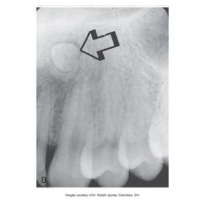 Dental X-ray showing an upper tooth with an arrow indicating the position of an impacted supernumerary tooth.