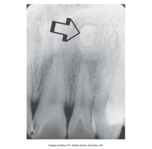 Dental X-ray highlighting the position of an impacted tooth in the upper jaw, marked by an arrow.