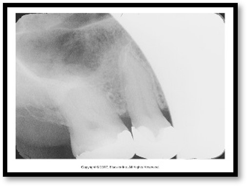 The image shows a dental X-ray featuring a clear view of tooth structures and surrounding bone, demonstrating effective use of the paralleling technique.