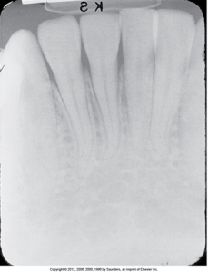 A dental radiograph showing an underexposed receptor, which appears too light, with unclear visibility of teeth and gum structures.