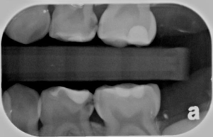 Dental X-ray showing the upper and lower molars of a patient.