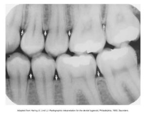 Dental X-ray showing several teeth with indicators pointing to specific areas of interest for diagnostic purposes.